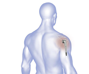 Anatomic Shoulder Replacement - Educational Picture
