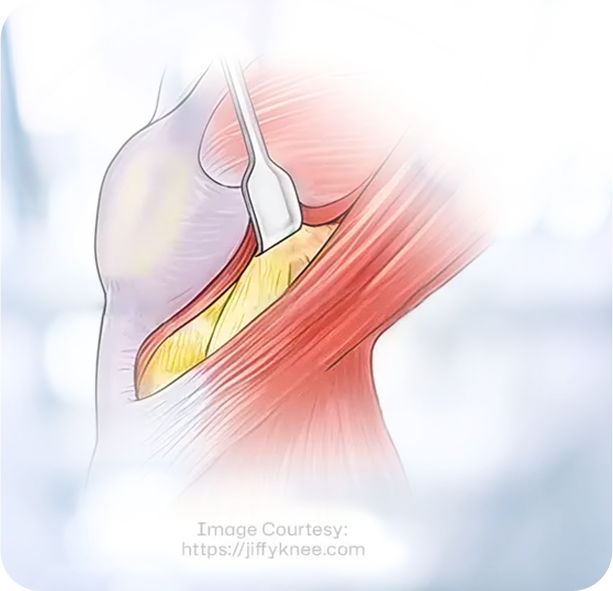 Muscle Sparing Jiffy Knee Replacement - Educational Picture